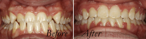 Common Orthodontic Problems Orthodontic Arts
