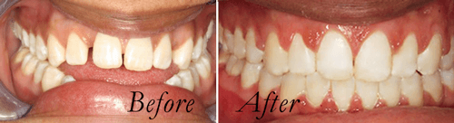 open bite before and after braces