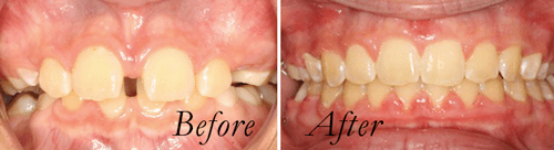 Spacing  before and after  braces